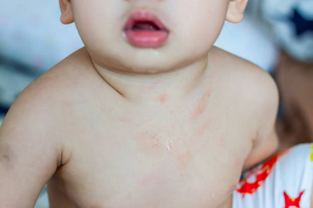 a teething baby with rashes