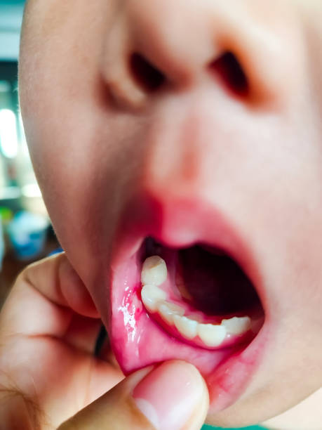 a child's mouth with canker sores