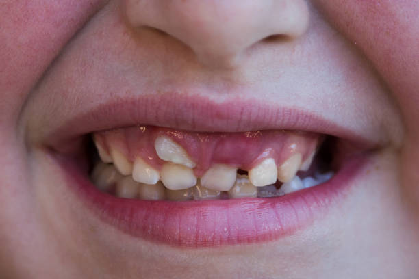 close-up image of a tooth growing in front of another tooth 