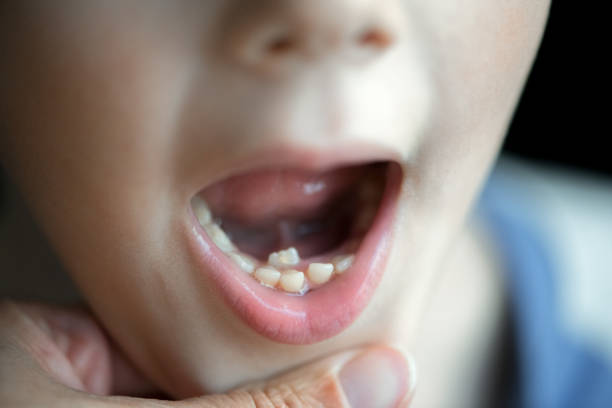 photo showing a tooth growing behind baby tooth