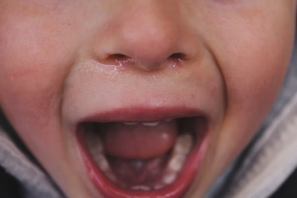 photo of a kid's teeth